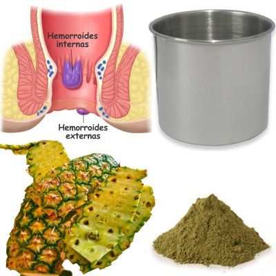 Hemorroides remedios
